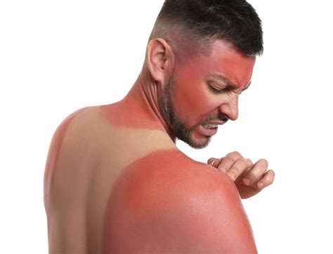 Sunburn On Face - Causes, Symptoms And Treatments - SkinKraft - balustradellc