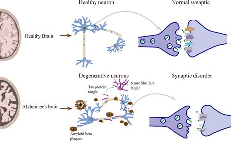 Synaptic degeneration in Alzheimer disease - Nature - muktibox.com