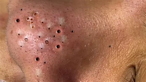 It looks like acne has formed around each and every hair follicle/pore on this person's face. . . . So much goo. 577K subscribers in the popping community. Subreddit for popping addicts and the pop-curious. Blackheads, pimples, cysts, abscesses, and more.. 