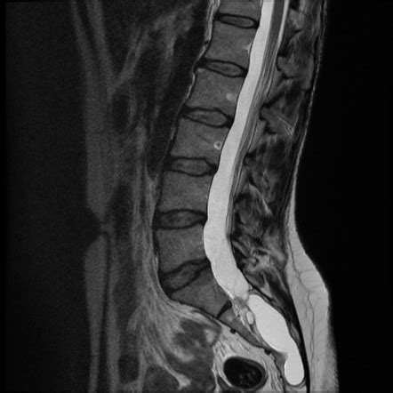 Sacral cyst Radiology Case Radiopaedia.org