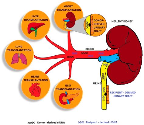 Safe removal of failed transplanted kidneys - PubMed