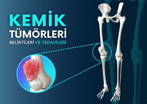 Salgı Bezlerinde Oluşan Iyi Huylu Tümör Bulmaca Cevapları. 
