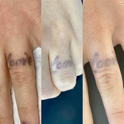 Removal. Saline Tattoo Removal can be done on old brow tattoos using a saline solution to lift pigment out through the skin. This is necessary if brows are .... 