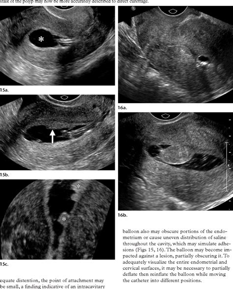 Saline-infused Sonohysterography: Tips for Achieving …