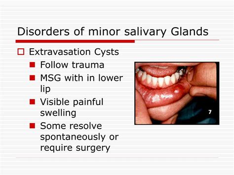 Salivary Abnormalities in Dentistry: Overview, Salivary Gland An…