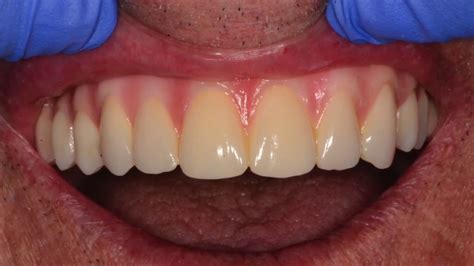 Same Day Denture Repair Near Me