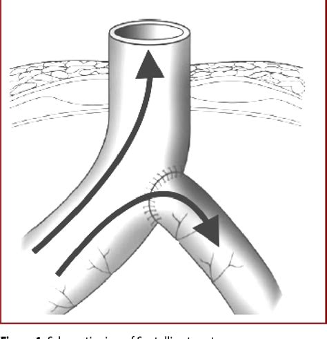 Santulli enterostomy is an advantageous technique in stoma closure …