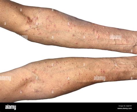 Scabies Infestation Pictures, Images and Stock Photos