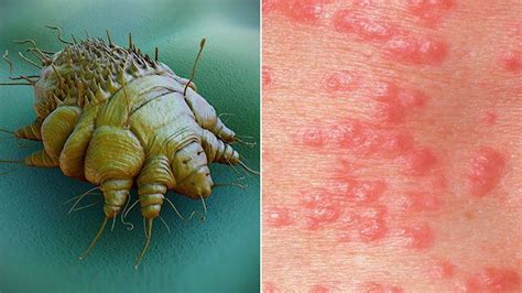 Scabies and Head Lice: Itchy Skin Conditions Caused by Parasites