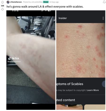 WARNING: Daniel Larson's scabies just mutated and are trying to take over the world. News. 
