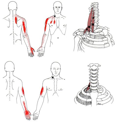 Scalene Group Trigger Points Learn Muscles