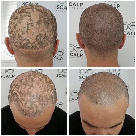 Scalp micro usa. At Scalp Micro USA, we pride ourselves on being at the cutting edge of hair loss solutions. Scalp micropigmentation is an alternative to short-term fixes like hairpieces and long-term solutions like hair transplants. The process is simple and looks natural. We have popular hairline styles to choose from, but we focus on customizing the ... 