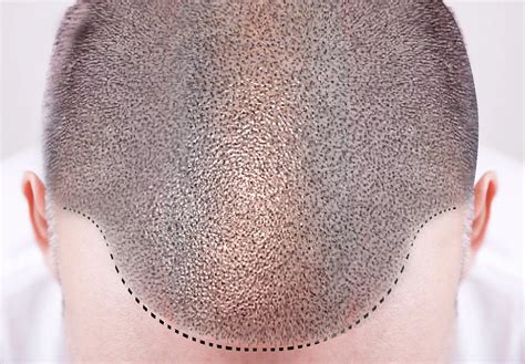 Scalp micropigmentation