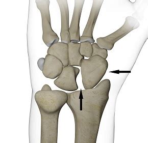 Scapho-Lunate Dissociation — Bone Talks