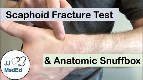 Scaphoid Fracture Test YouTube