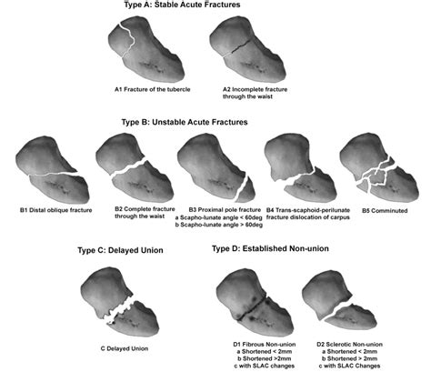Scaphoid fracture compensation amounts.  How much scaphoid fracture compen...
