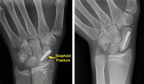 Scaphoid fracture compensation amounts.  The scaphoid is especially imp...