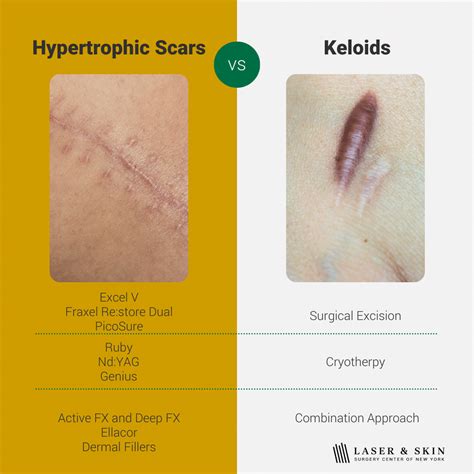 Scar Treatment NYC Keloid Treatment NYC - JUVA Skin