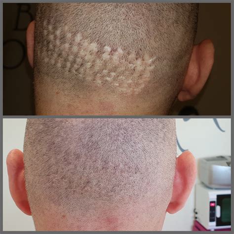Scar camouflage tattoo. In scar camouflage treatment, the tattoo artist places the dots on the scarred tissue, making it seem like a natural part of the scalp with hair follicles. People who experience hair loss and undergo hair loss reversal procedures often face a lot of embarrassment and ridicule from society. 
