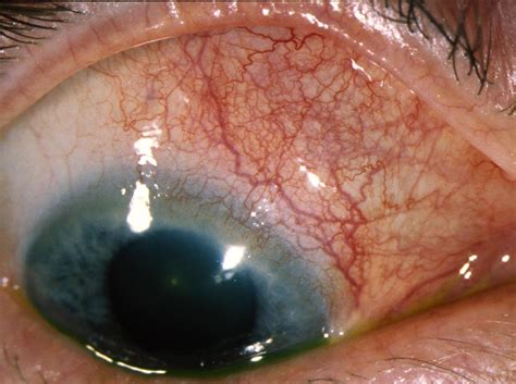 Sceleritas. In some cases, scleritis may also have infectious causes. Bacteria, mycobacterium, pseudomonas, parasites, fungi, or viruses can also cause scleritis. In addition, exposure to chemicals or trauma can also … 