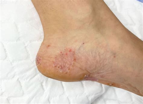 Scenario: Management of fungal skin infection - foot