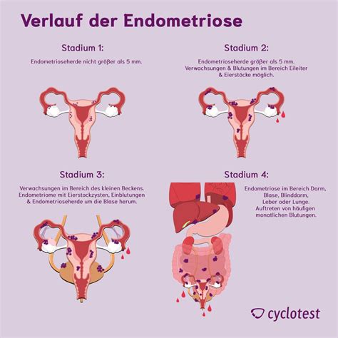 Schmerzen Nach Sex Endometriose