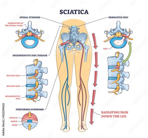 Sciatica and Radicular (Nerve Related) Back and Leg Pain