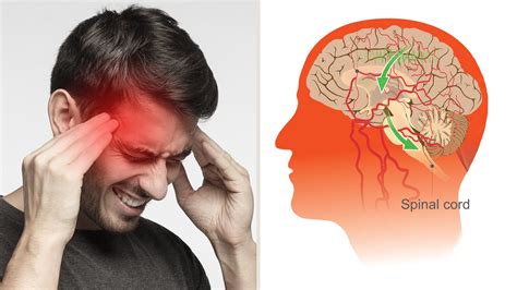 Science of Migraine Headache NewsBlog