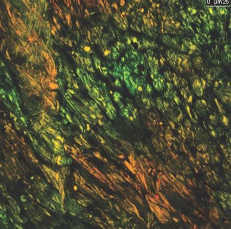 Scientists Show How Cells React to Injury From Open Heart Surgery
