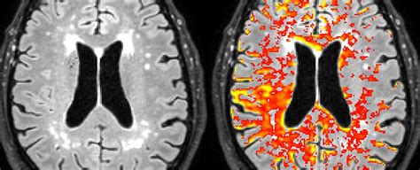 Scientists Show How Defects in Blood Brain Barrier Could Cause Neurological Disorder