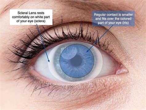 Scleral lenses are customized rigid lenses that tackle three factors simultaneously: they provide vision correction, they protect the eye and serve a therapeutic purpose by …. 