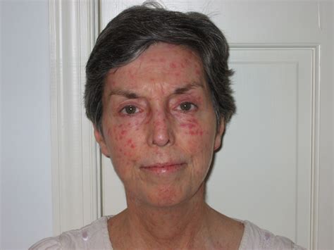 Scleroderma Face