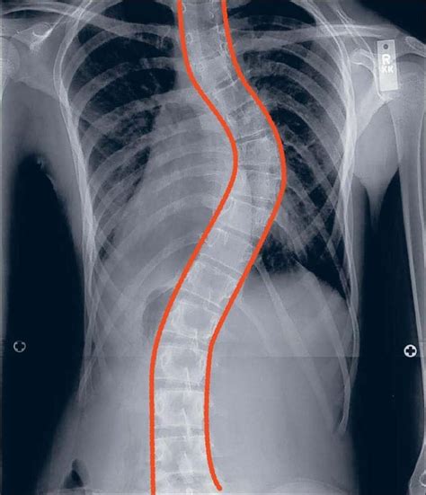 Scoliosis Nutrition Plays a Key Role in Correcting …