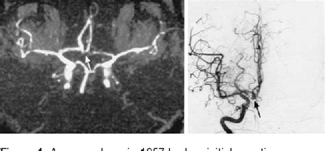 Screening for familial intracranial aneurysms The BMJ