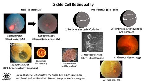 Sea fan sickle cell.  Individuals with sickle cell retinopathy commonly exhibit peripher...