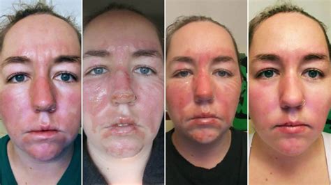 Seal Face Burn: A Comprehensive Guide to Prevention, Treatment, and Recovery