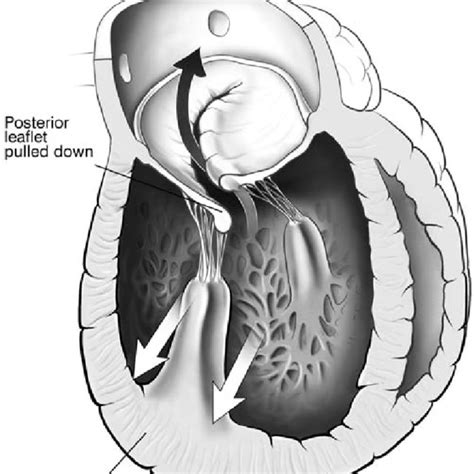 Search Page 1/20: LEFT VENTRICULEAR DILATATION