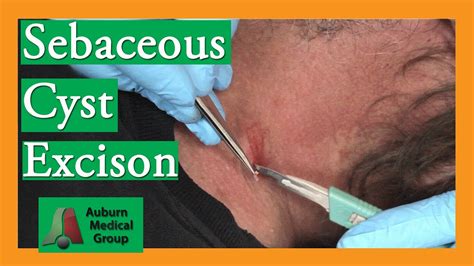 Sebaceous cyst excision cpt code. However, a benign lesion excision (CPT 11400-11446) must have medical record documentation as to why an excisional removal, other than for cosmetic purposes, ... 