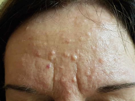 Sebaceous hyperplasia pictures. .  <a href=https://www.ano-centr.ru/jpg19...