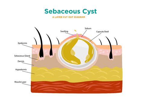 Sebacious cyst labia. Sebaceous cysts are caused by blocking of the duct of the multiple sebaceous glands of the hair-bearing surface of the vulva. Sebaceous retention cysts … 