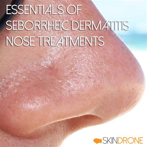 Seborrheic Dermatitis on the Nose - The Complete Guide - SkinDrone