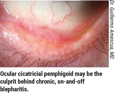 Seborrheic blephartis - Dry Eye Zone Forums