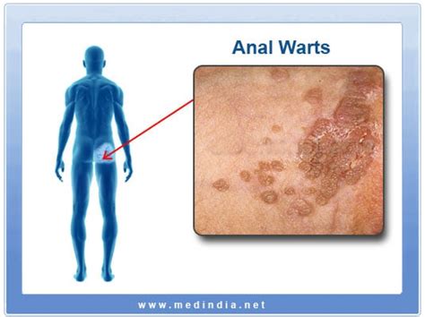 Second Opinion] looking for answers related to anal warts from HPM, HPV ...