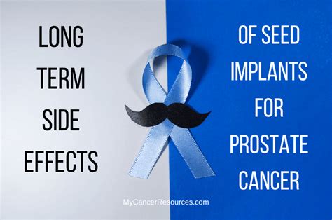 Seeds vs. prostatectomy: Long- and short-term side effects differ slightly