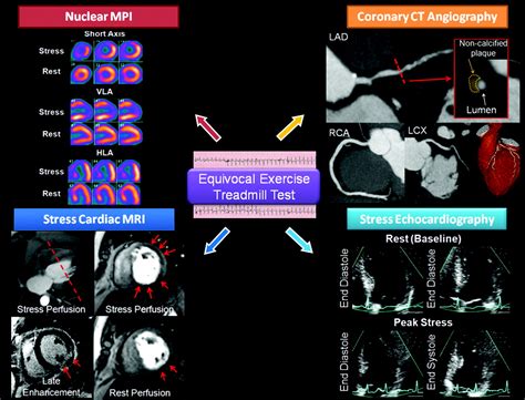Selecting a Noninvasive Imaging Study After an Inconclusive Exercise