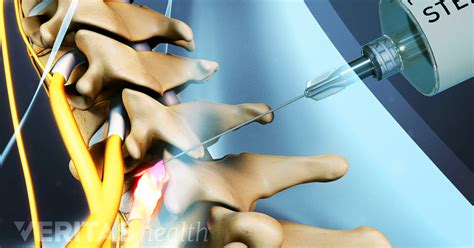 Selective Nerve Root Block