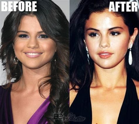 Selena gomez nose job. Not to mention an eyebrow lift a few years ago, ponytail lift (in the last year), nose job(s), chin implant, cheek filler (possibly implants), breast implants, buccal fat removal, etc. ... Wow, I haven't seen Selena Gomez's pics or videos for a long time, she looks so different and like the rest of the actresses who have done Botox in hollywood ... 