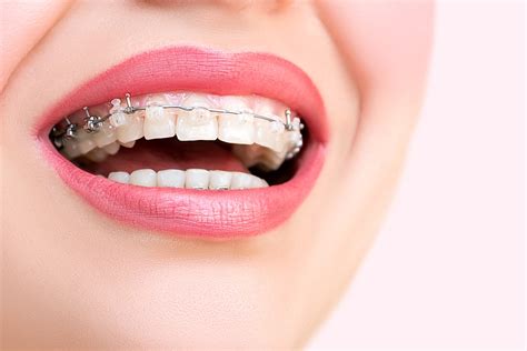 Self-Ligating Braces in Ponce — 3 Medical Centers — Nicelocal.com