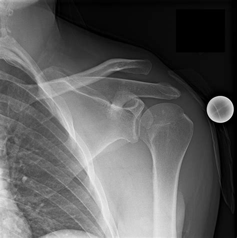 Separated Shoulder(Grade 1?) Anyone else have this injury? I ... - Reddit