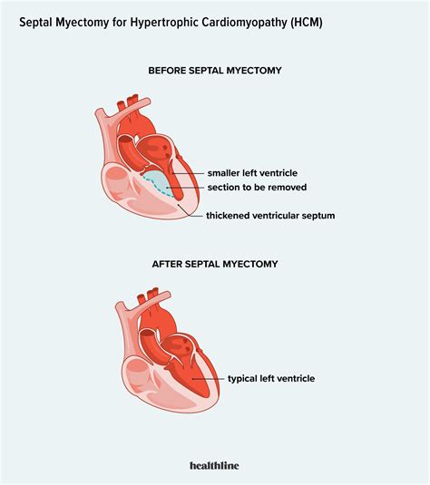 Septal Myectomy Procedure Risks Recovery and Outlook